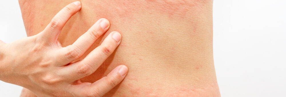 Hives and Anaphylaxis
